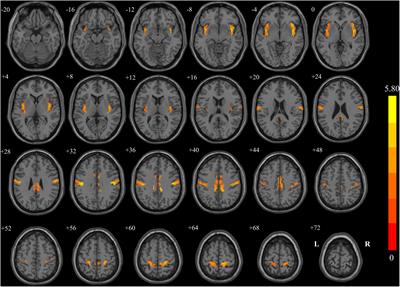 Modulation of Interhemispheric Functional Coordination in Breast Cancer Patients Receiving Chemotherapy